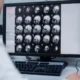 SPECT scan and fMRIs